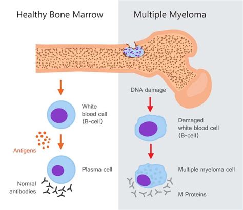 multiple myeloma cancer